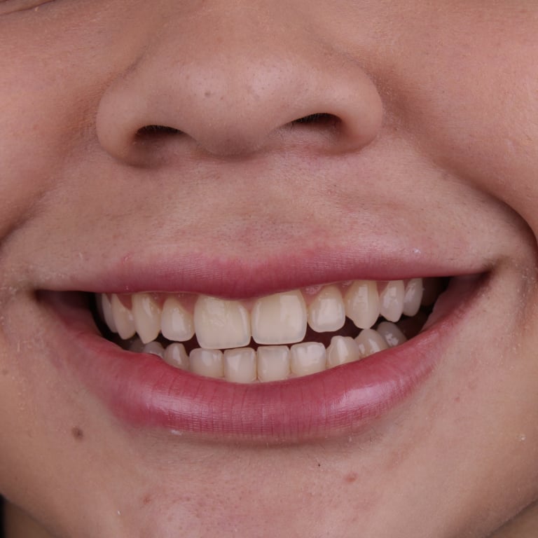 Dentes amarelados antes da lente de contato dental