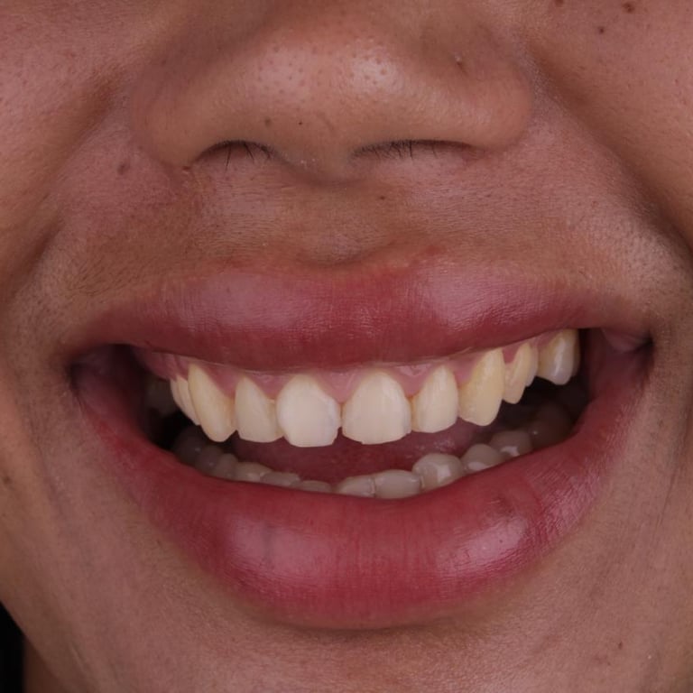 Dentes espaçados antes da lente de contato dental