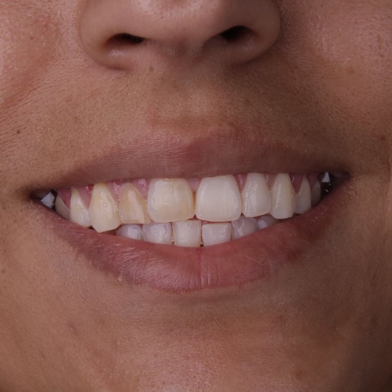 Dentes pequenos e sorriso infantil antes das lentes