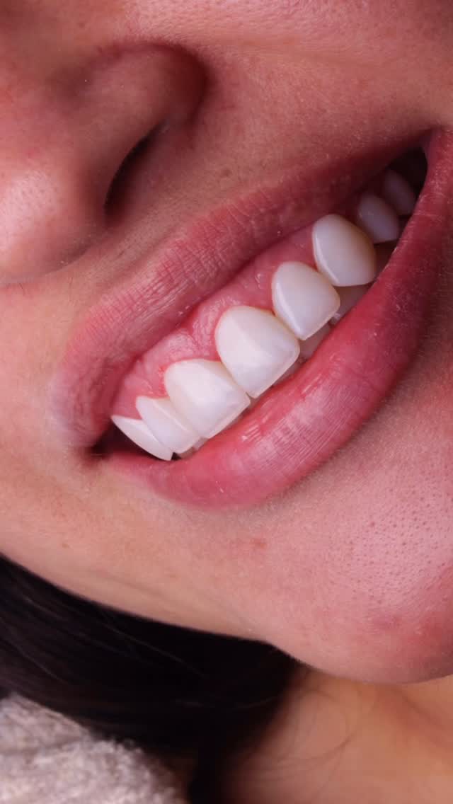 Detalhe da textura da resina na lente de contato dental