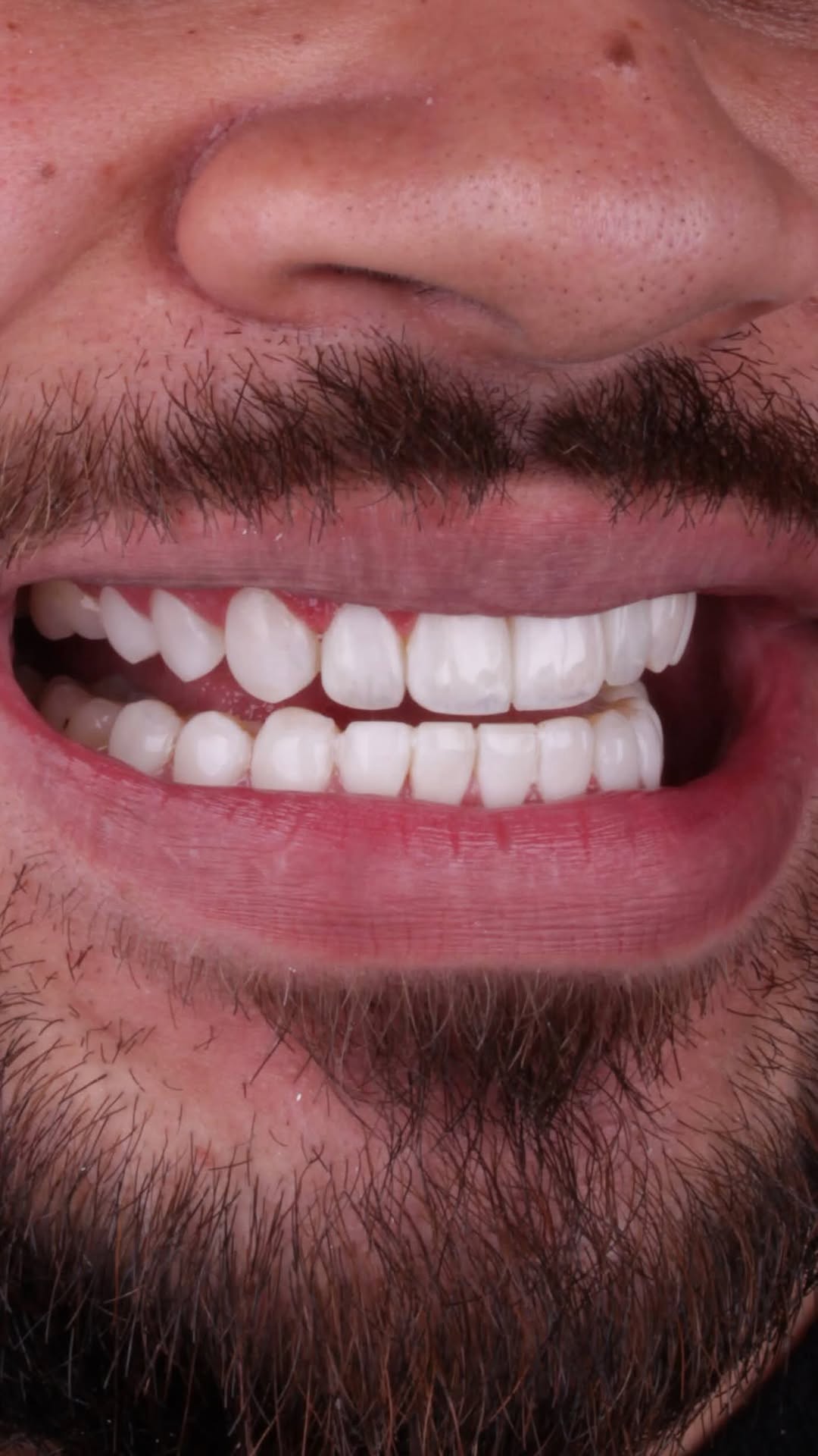 Arcada superior e inferior com lente de contato dental