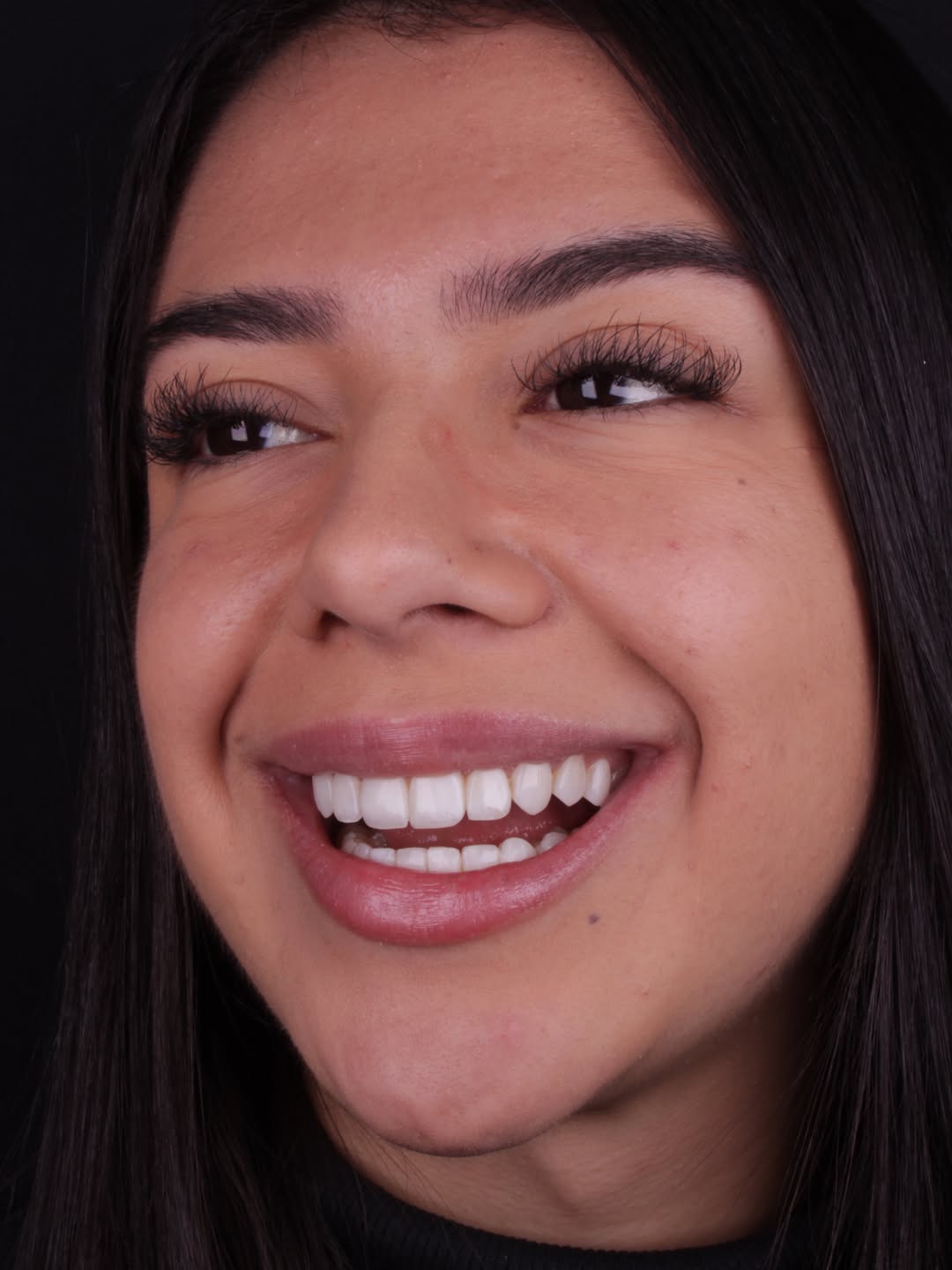 Detalhe do sorriso com lente de contato dental