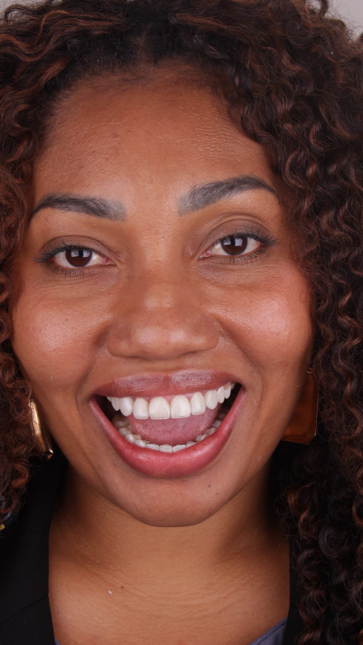 Gargalhada revelando lente de contato dental