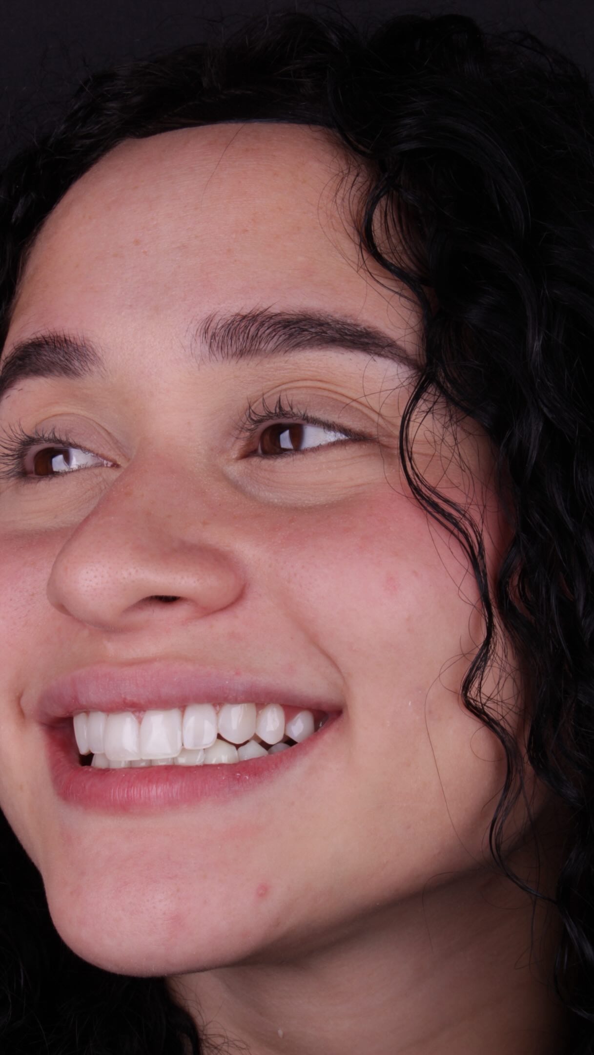 Lente de contato dental sob luz natural