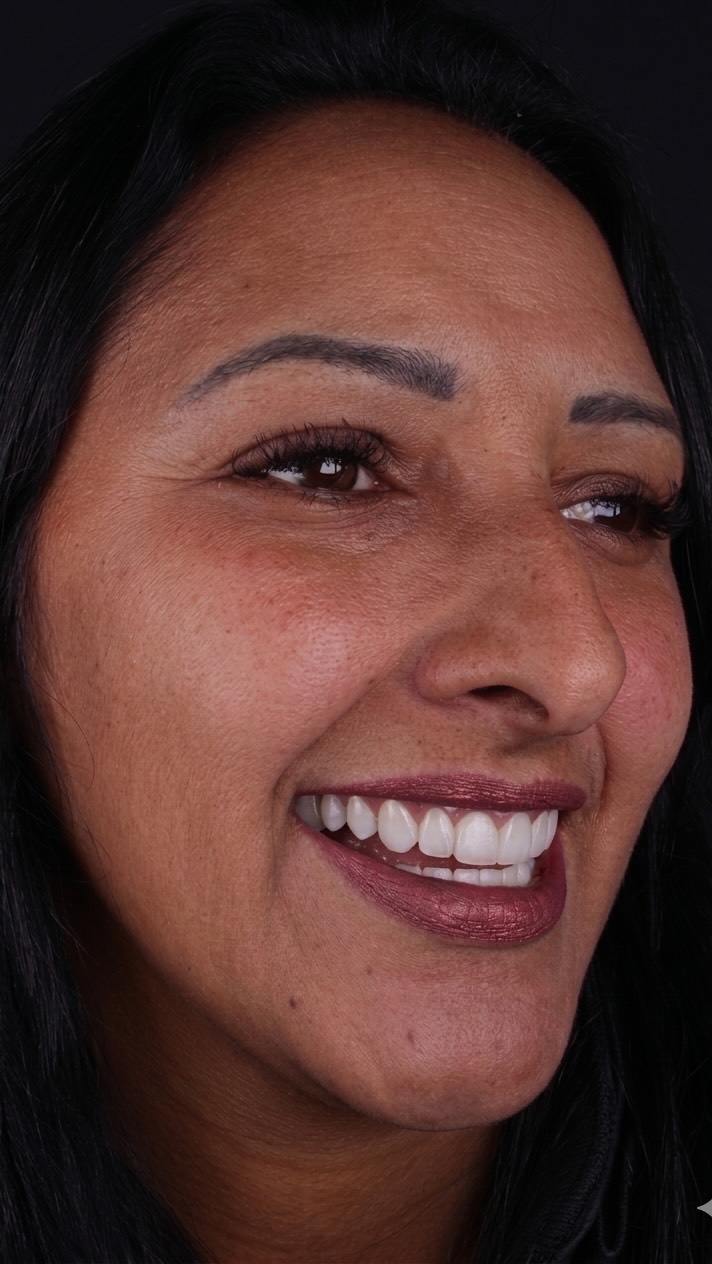 Perfil de sorriso com lente de contato dental