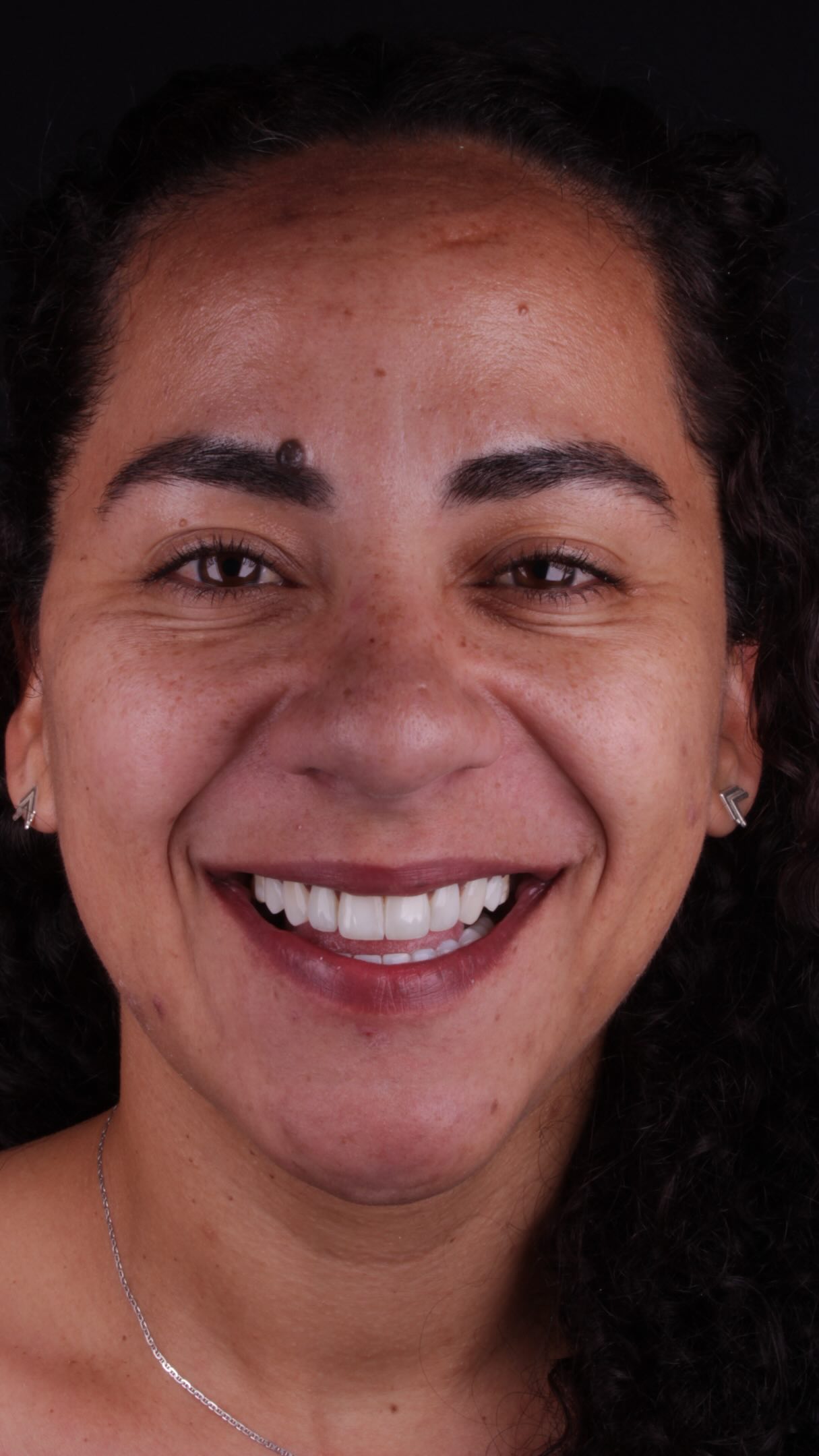 Sorriso aberto com lente de contato dental