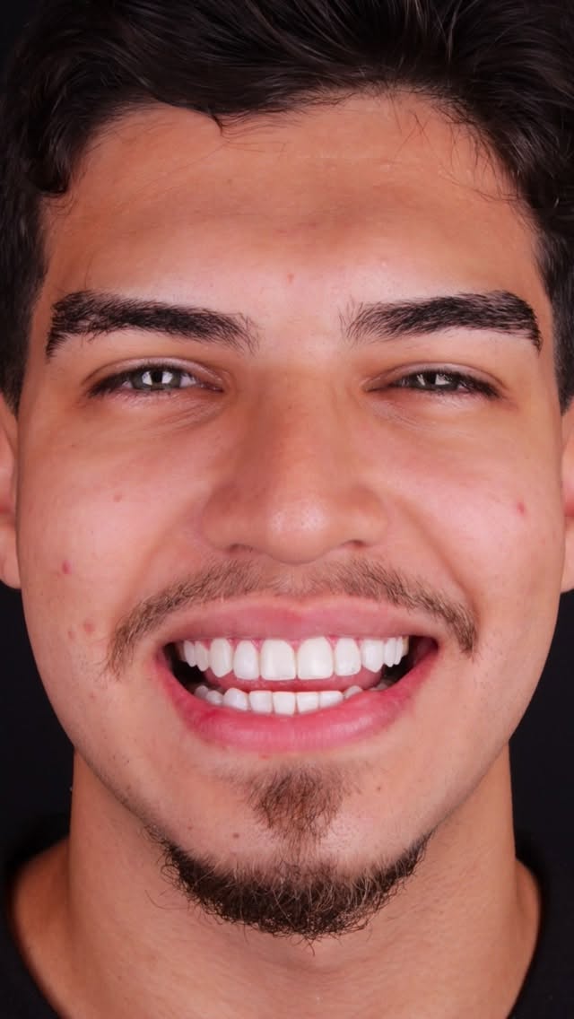 Resultado de lente de contato dental em paciente homem