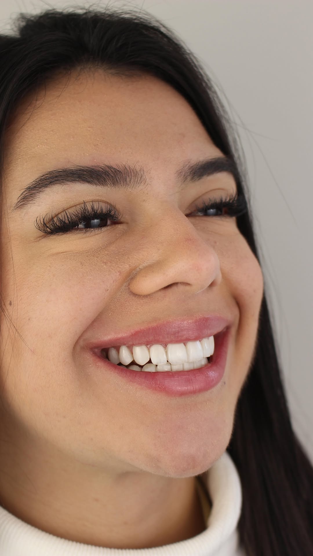 Resultado de lente de contato dental — sorriso suave e natural